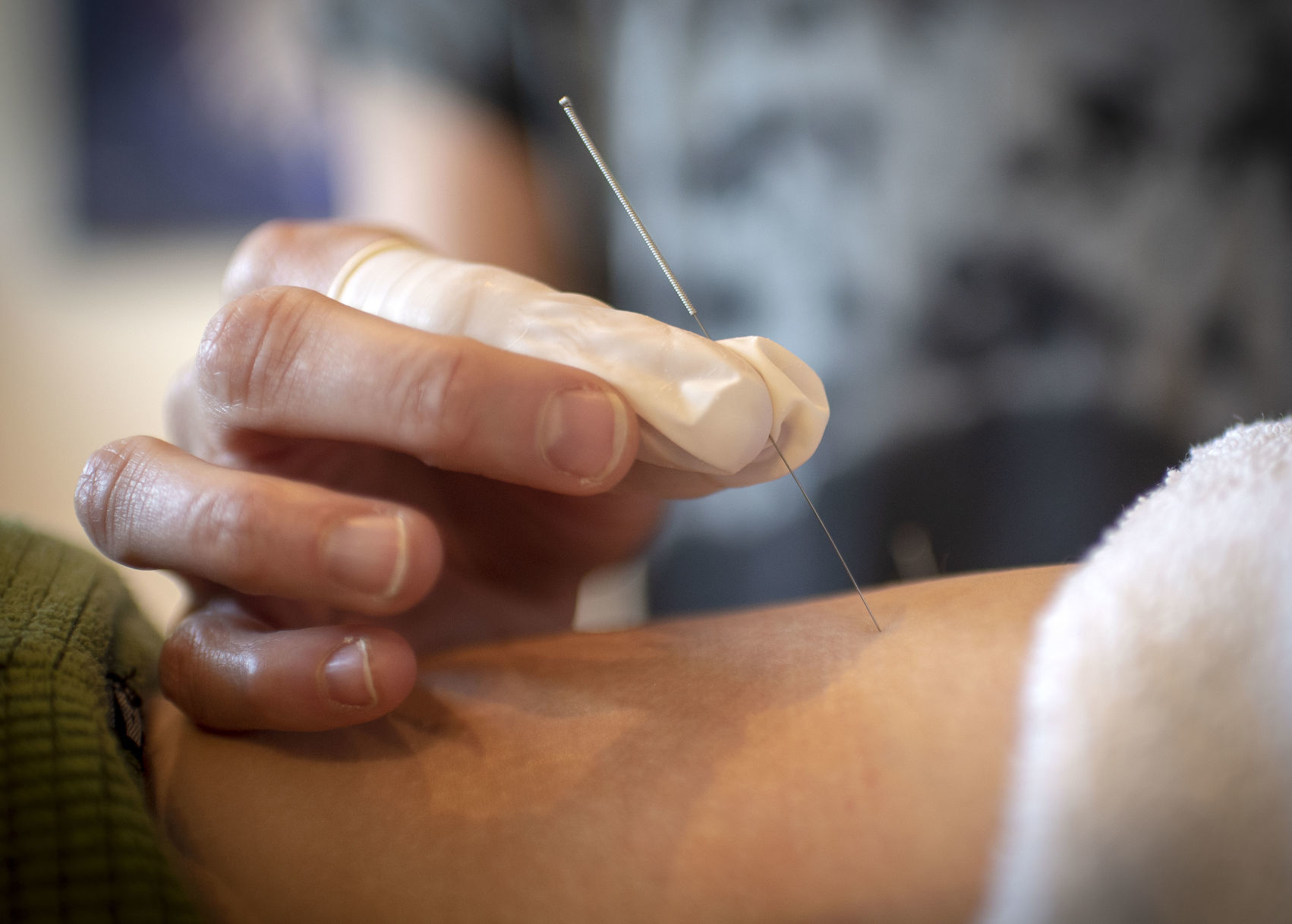 Dry needling